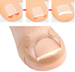 Hyggear Set de uñas encarnadas con tiras transpirables para uñas encarnadas